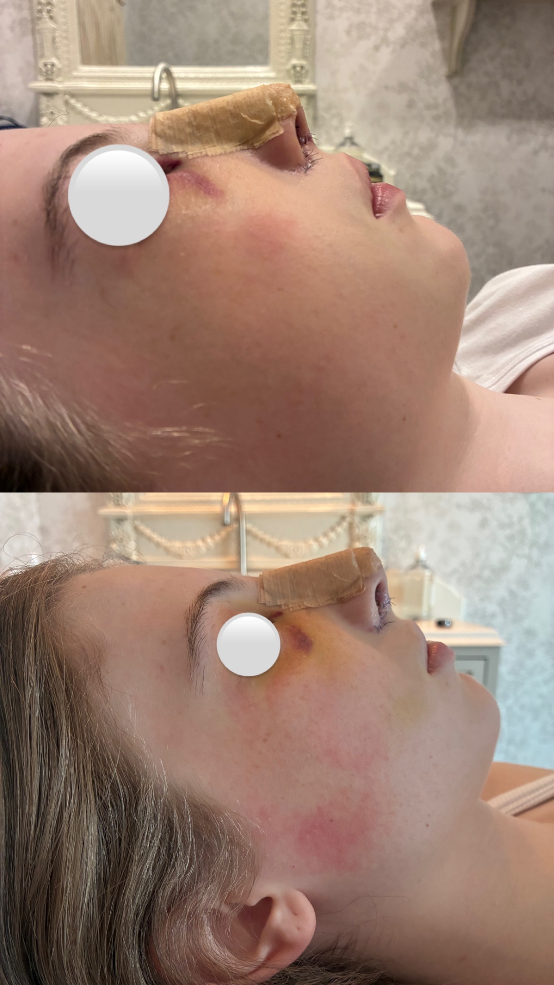 Pós-operatório de rinoplastia