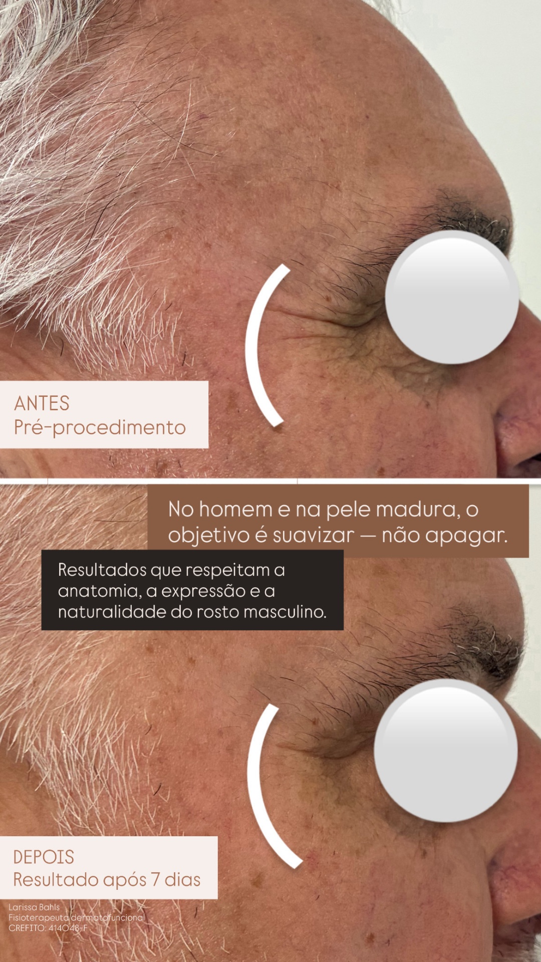 Suavização de expressão — pele madura